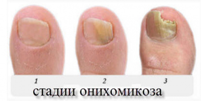 Симптомы грибка ногтей